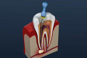 root canal