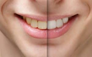 before and after whitening