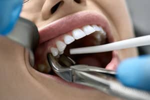 tooth extraction claremont nc