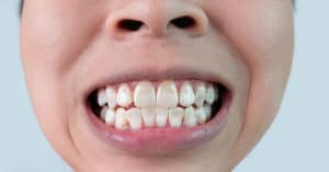 white spots on teeth