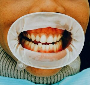 Causes and prevention of gum disease