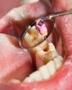 Benefits of Root Canals: Saving Your Natural Teeth