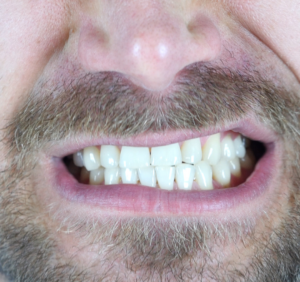 Symptoms of Teeth Grinding: When to Seek Medical Care