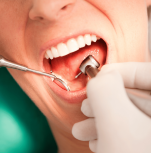 Discover the Transformative Benefits of Professional Dental Cleaning