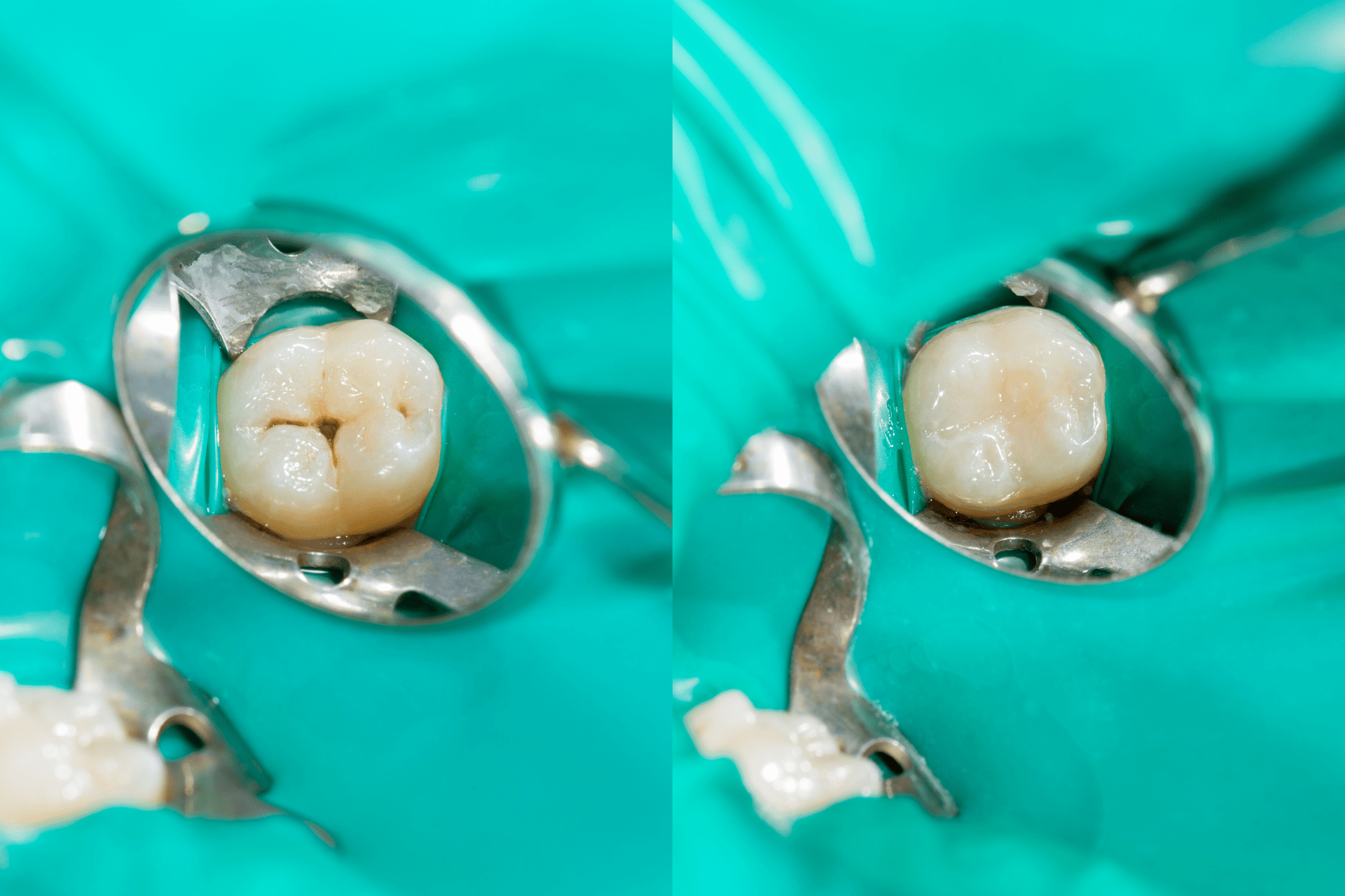 composite-fillings-1