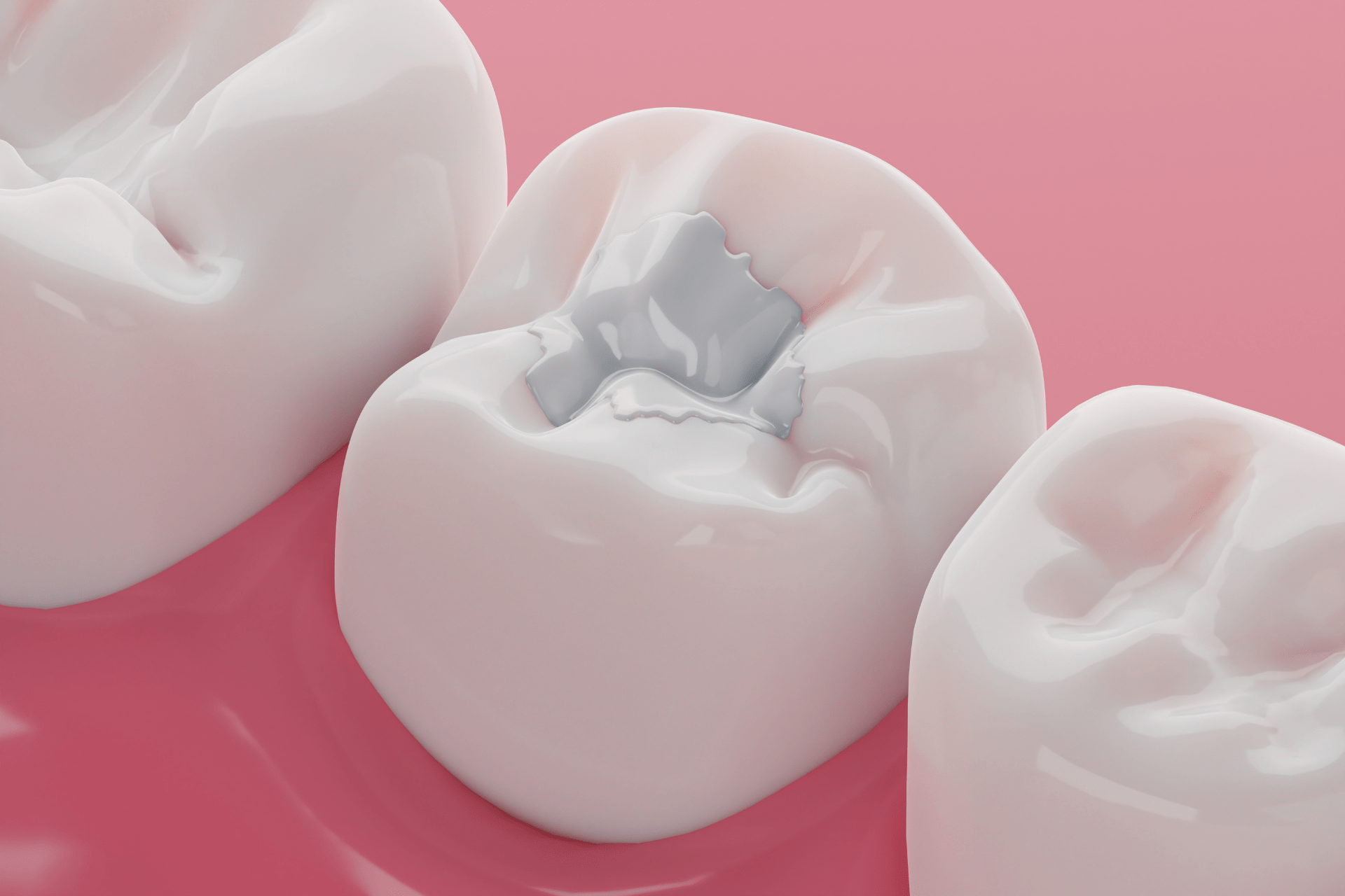 composite-fillings-3