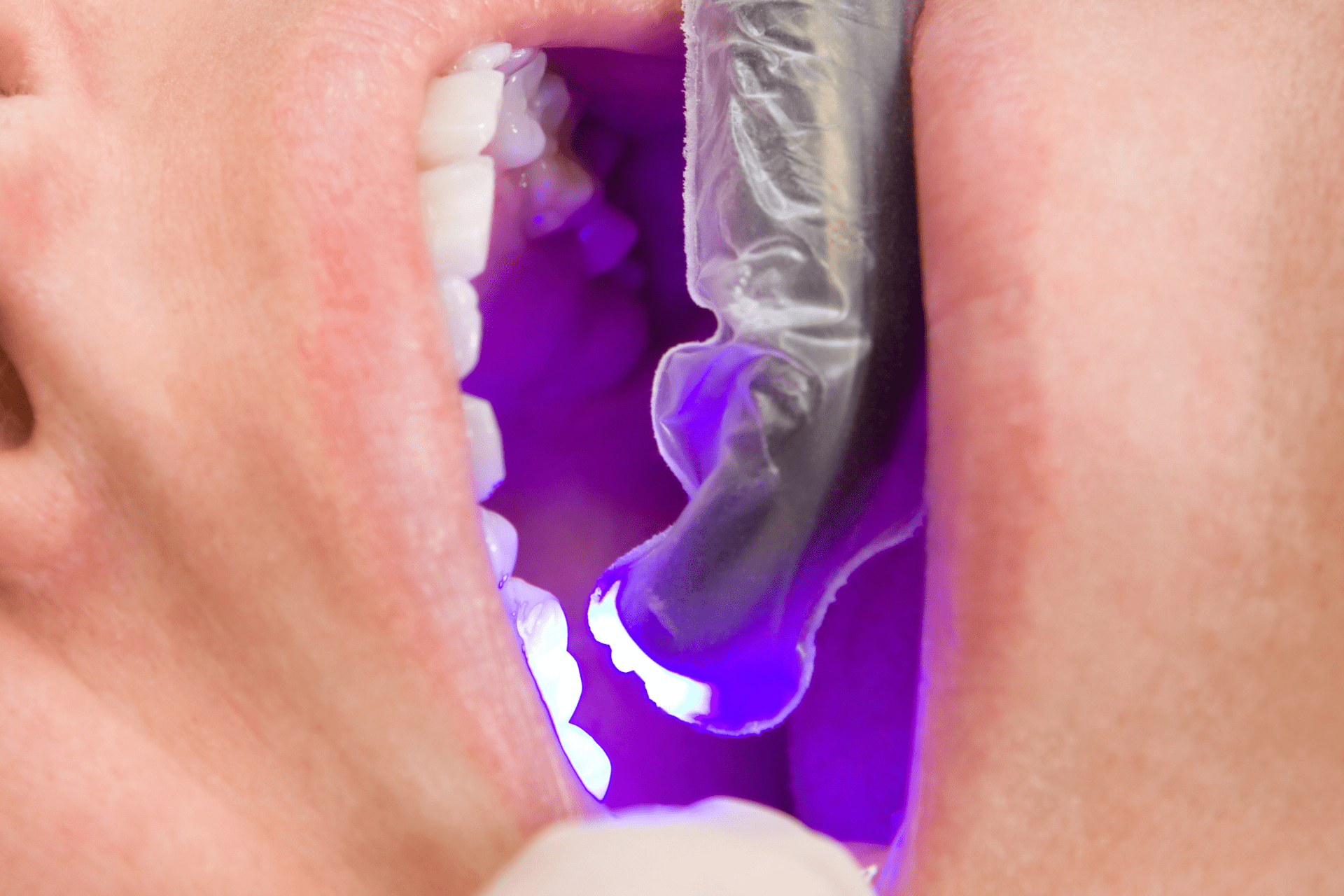 composite-fillings-6