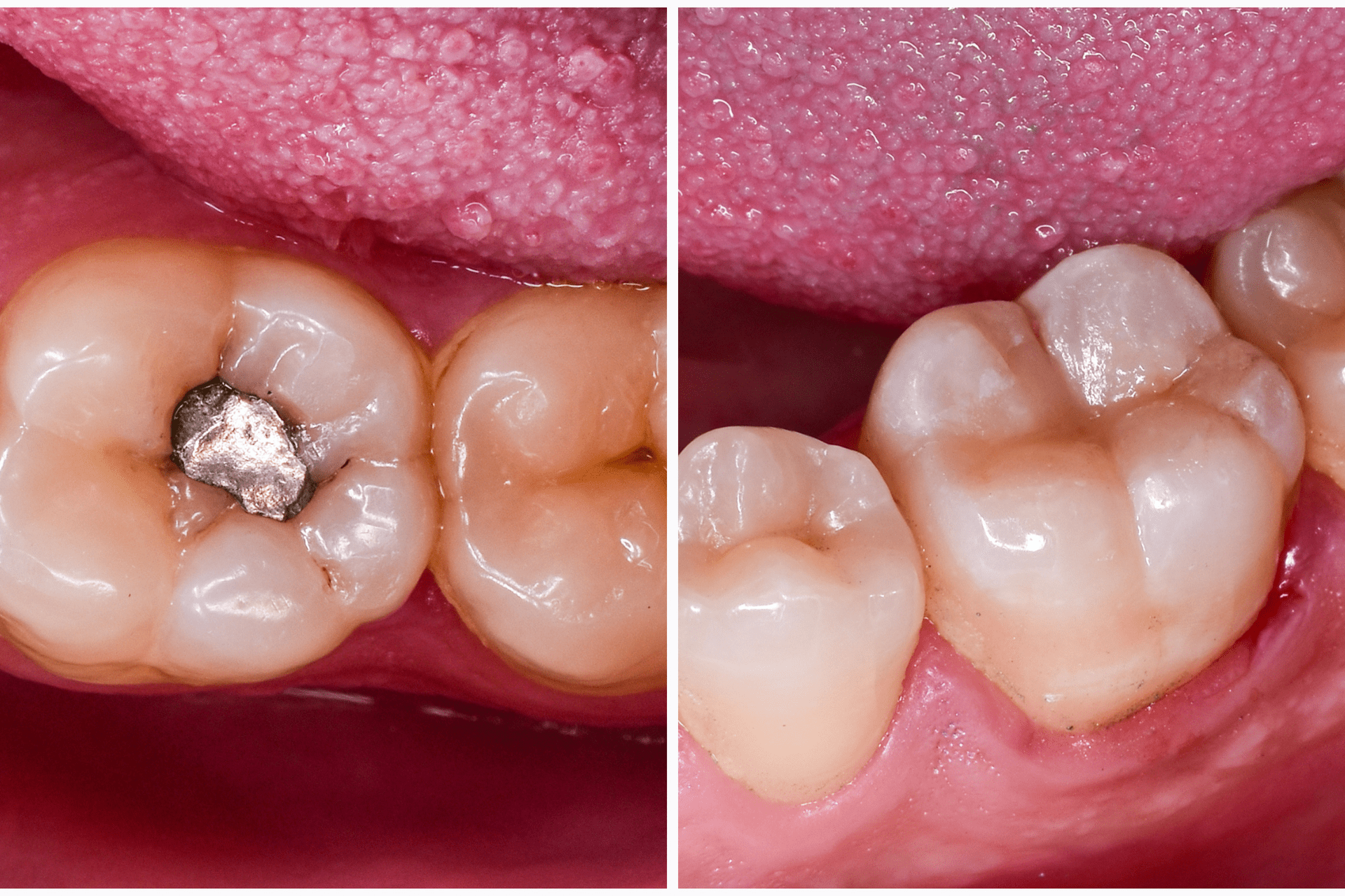 composite-fillings-9